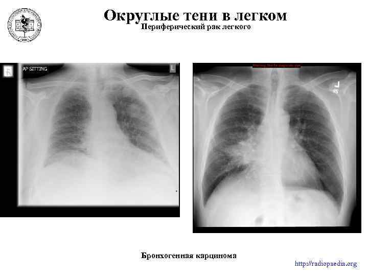 Округлые тени в легком Периферический рак легкого Бронхогенная карцинома http: //radiopaedia. org 