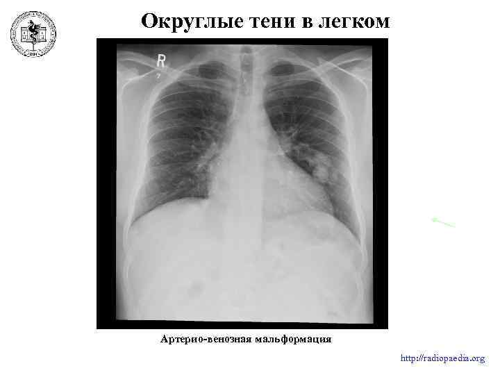 Округлые тени в легком Артерио-венозная мальформация http: //radiopaedia. org 
