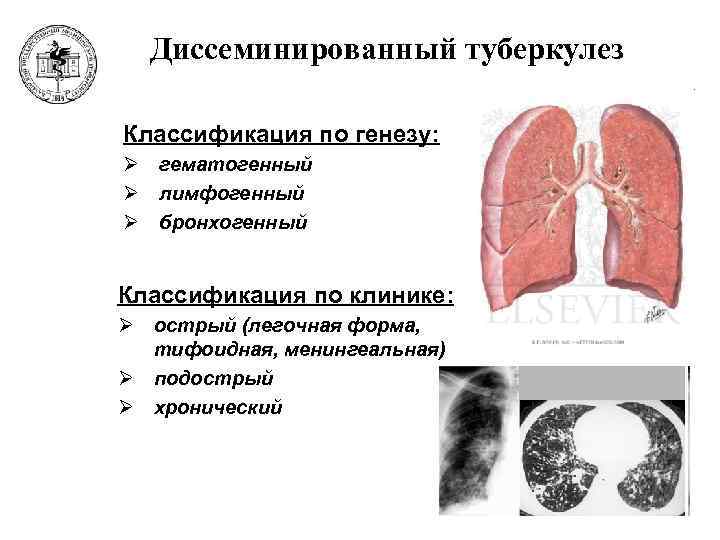 Формы диссеминированного туберкулеза. Острый диссеминированный туберкулез классификация. Хронический гематогенно-диссеминированный туберкулез кт.