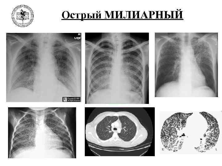 Милиарный туберкулез легких схема