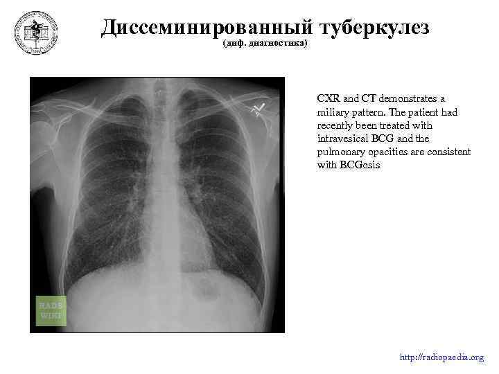 Милиарный туберкулез легких схема