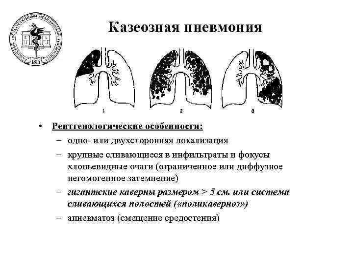 Осложнение очаговой пневмонии. Казеозная пневмония рентген. Казеозная пневмония рентген синдром. Туберкулез легких схемы казеозная пневмония. Двусторонняя казеозная пневмония рентген.