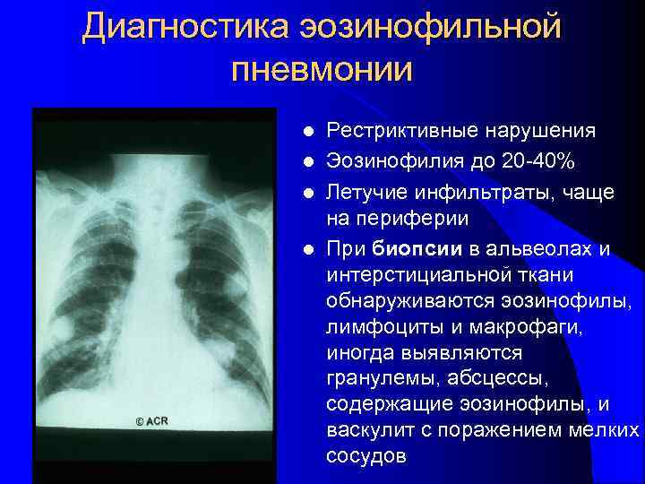 Эозинофильная пневмония презентация