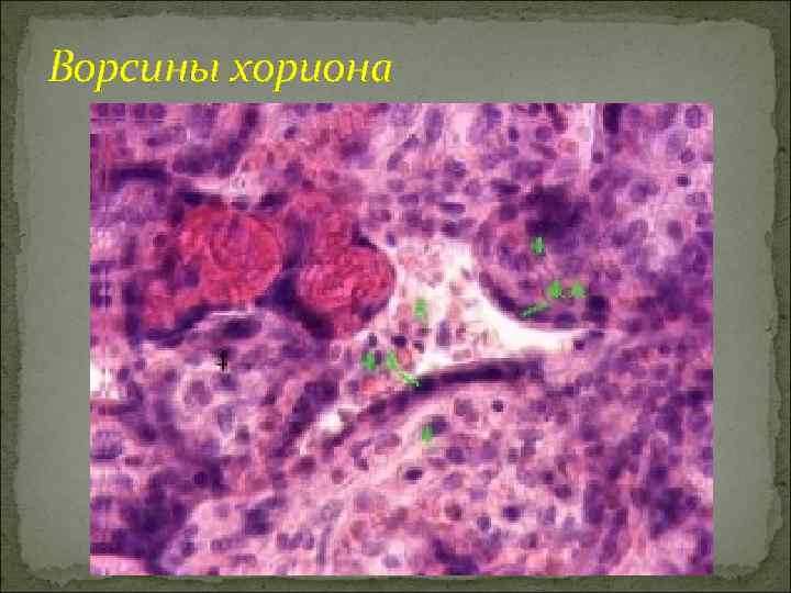 Ворсины хориона 