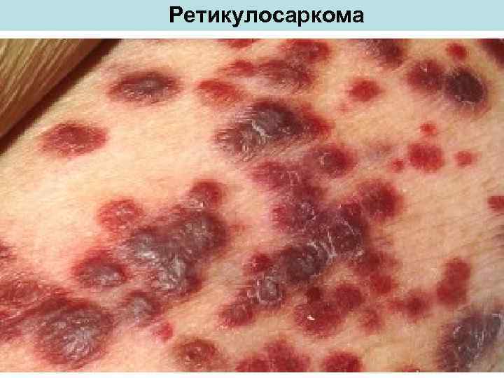 Ретикулосаркома 