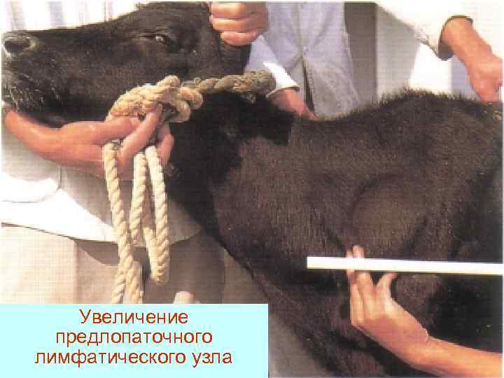   Увеличение  предлопаточного лимфатического узла 