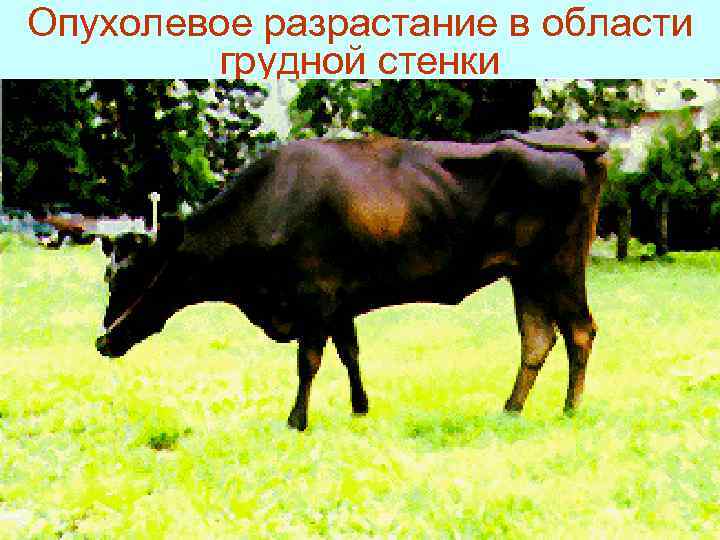 Опухолевое разрастание в области  грудной стенки 