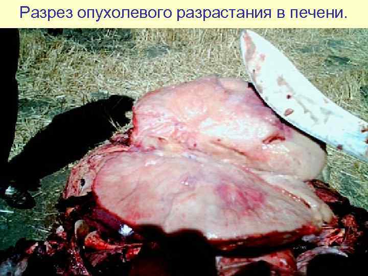 Разрез опухолевого разрастания в печени. 