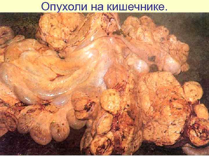 Опухоли на кишечнике. 