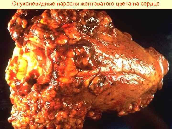 Опухолевидные наросты желтоватого цвета на сердце 