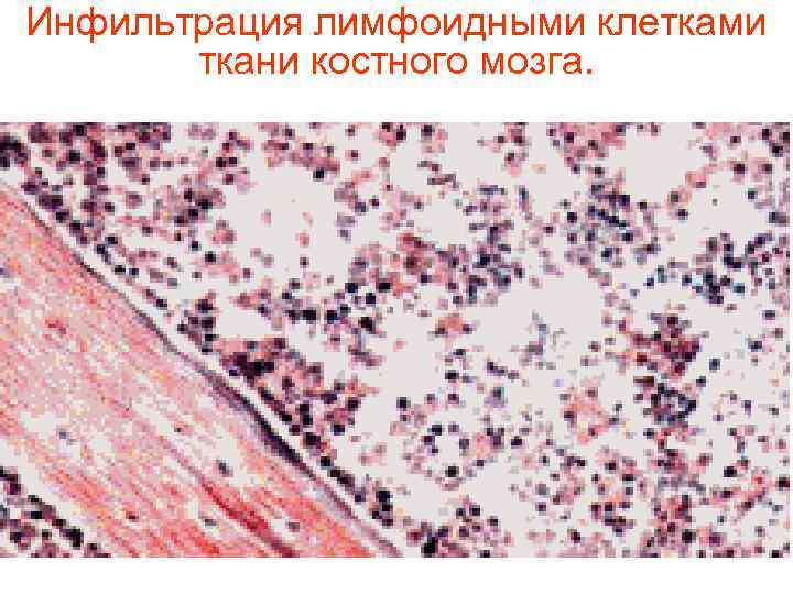 Инфильтрация лимфоидными клетками   ткани костного мозга.  