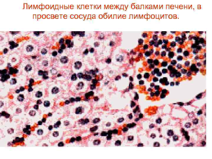 Лимфоидные клетки между балками печени, в  просвете сосуда обилие лимфоцитов.  
