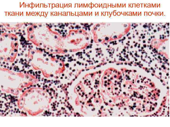 Инфильтрация тканей. Лейкемическая инфильтрация почки микропрепарат. Лейкоз почки микропрепарат. Лейкозные инфильтраты почки микропрепарат. Лейкозная инфильтрация гистология.