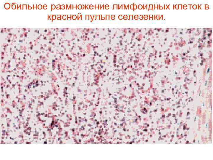 Обильное размножение лимфоидных клеток в   красной пульпе селезенки.  