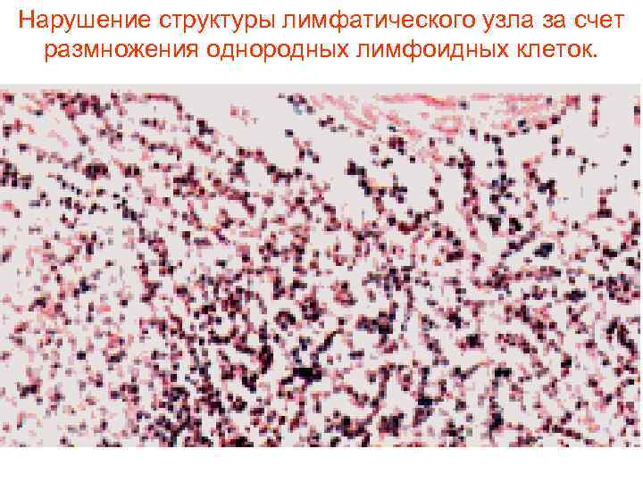 Нарушение структуры лимфатического узла за счет  размножения однородных лимфоидных клеток.  
