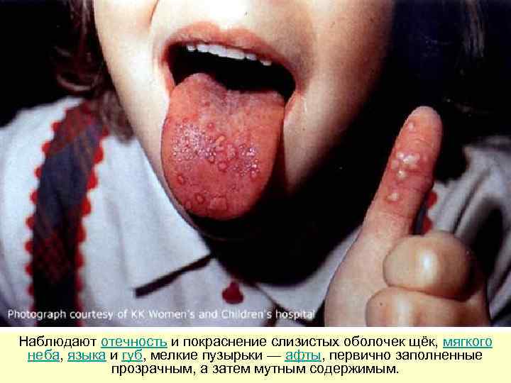 Наблюдают отечность и покраснение слизистых оболочек щёк, мягкого  неба, языка и губ, мелкие