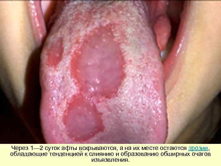 Через 1— 2 суток афты вскрываются, а на их месте остаются эрозии,  обладающие