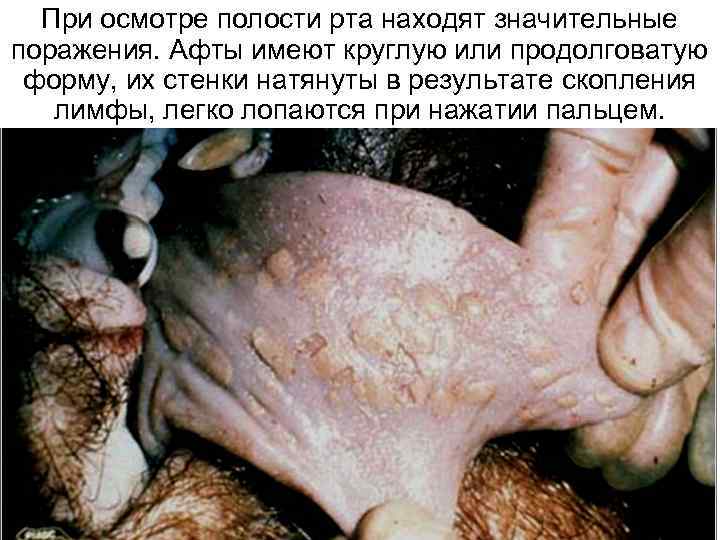  При осмотре полости рта находят значительные поражения. Афты имеют круглую или продолговатую 
