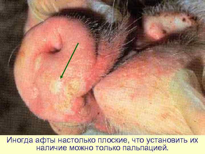 Иногда афты настолько плоские, что установить их   наличие можно только пальпацией. 