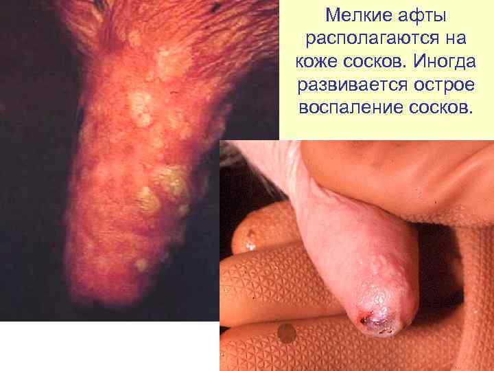   Мелкие афты  располагаются на коже сосков. Иногда развивается острое воспаление сосков.