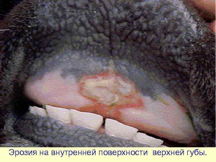 Эрозия на внутренней поверхности верхней губы. 