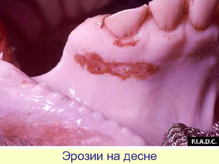 Эрозии на десне 