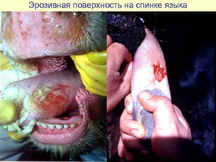 Эрозивная поверхность на спинке языка 