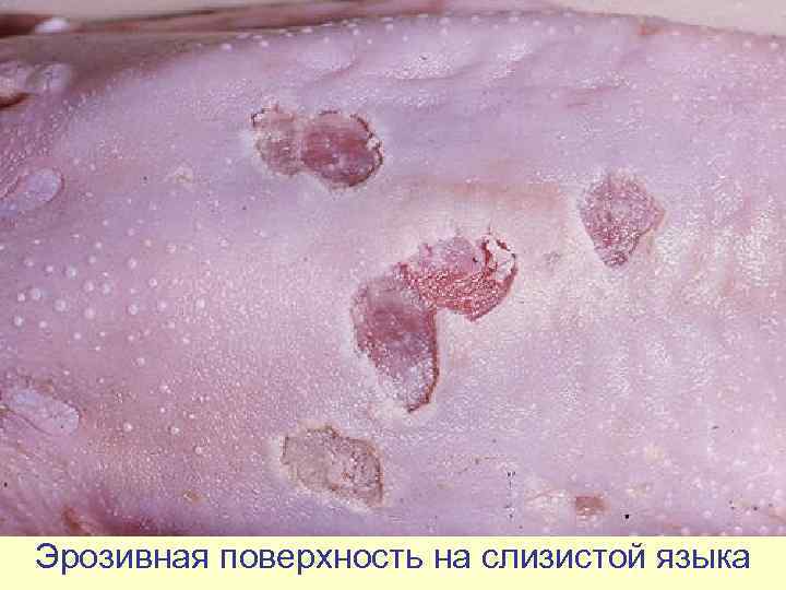Эрозивная поверхность на слизистой языка 