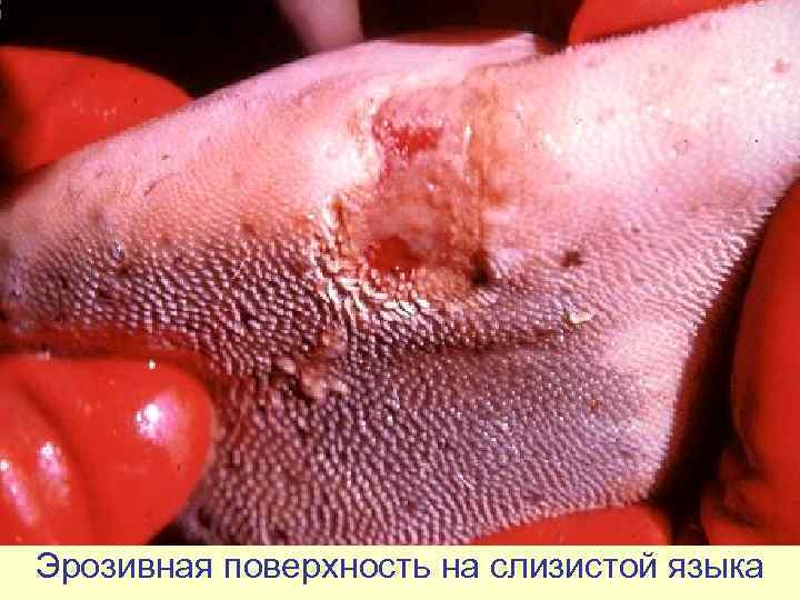 Эрозивная поверхность на слизистой языка 