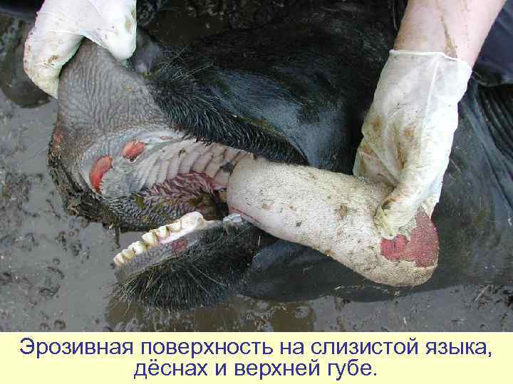 Эрозивная поверхность на слизистой языка,  дёснах и верхней губе. 