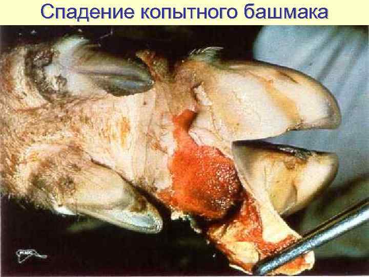 Спадение копытного башмака 