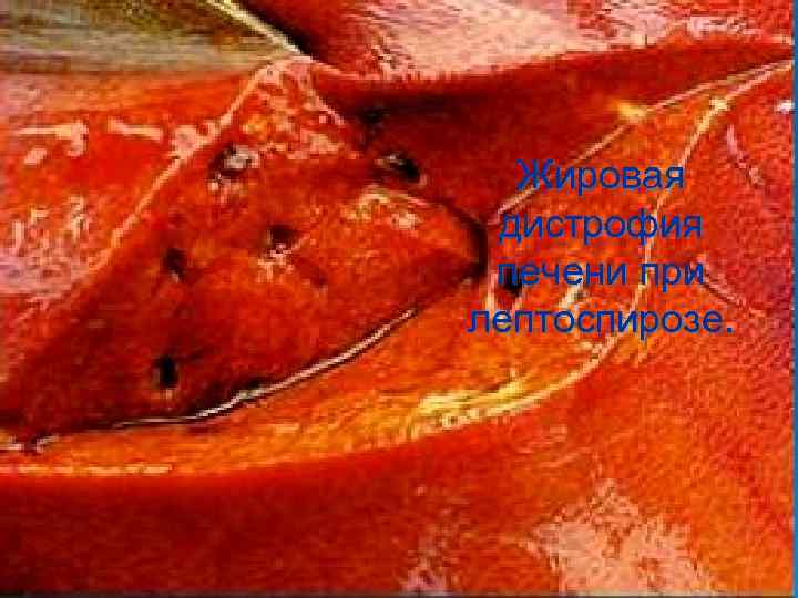  Жировая дистрофия печени при лептоспирозе. 