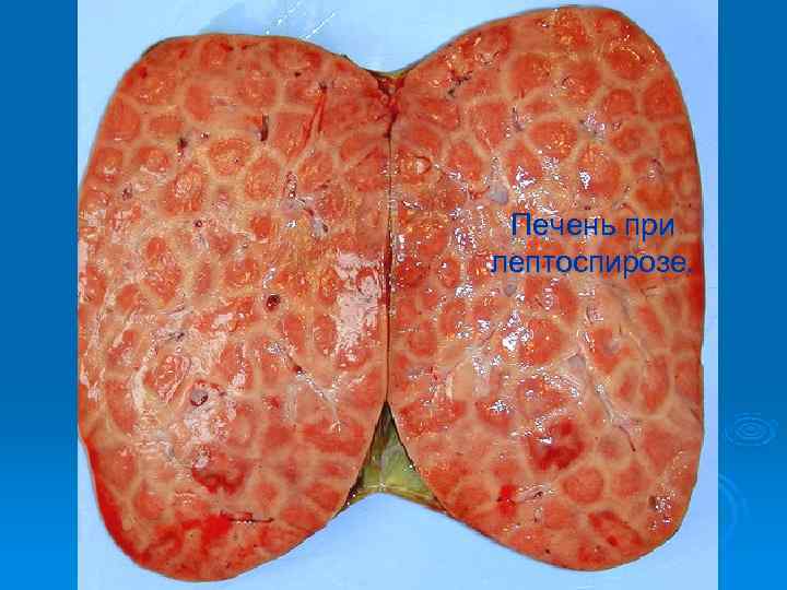  Печень при лептоспирозе. 