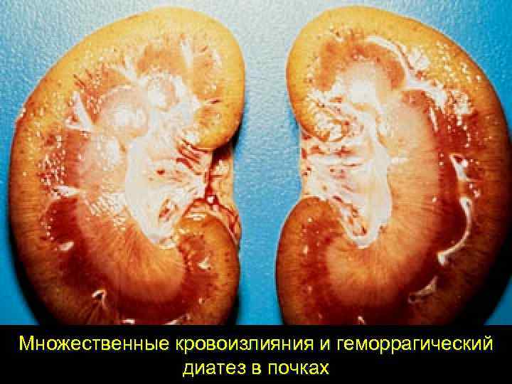 Множественные кровоизлияния и геморрагический    диатез в почках 