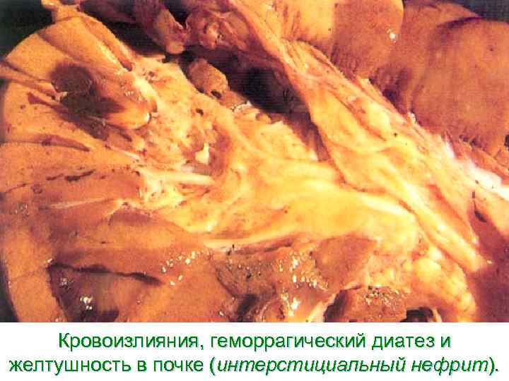   Кровоизлияния, геморрагический диатез и желтушность в почке (интерстициальный нефрит). 