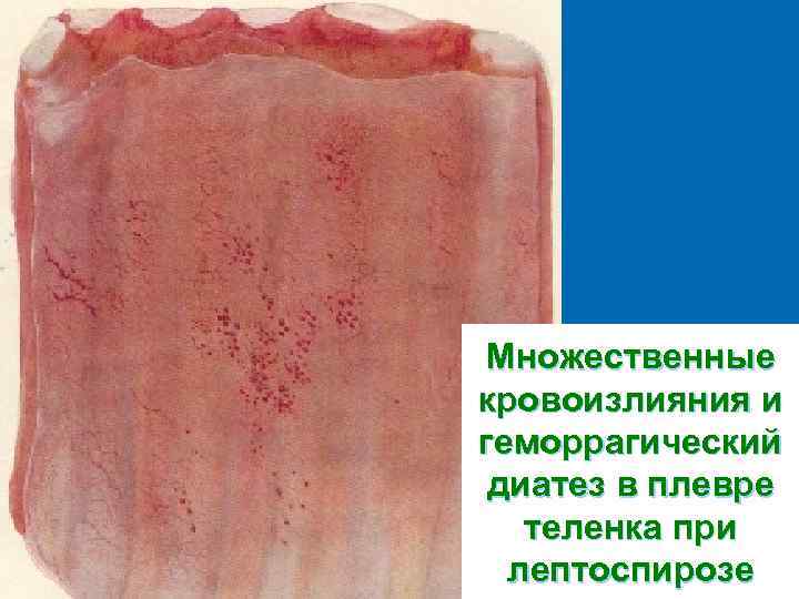 Множественные кровоизлияния и геморрагический диатез в плевре  теленка при  лептоспирозе 