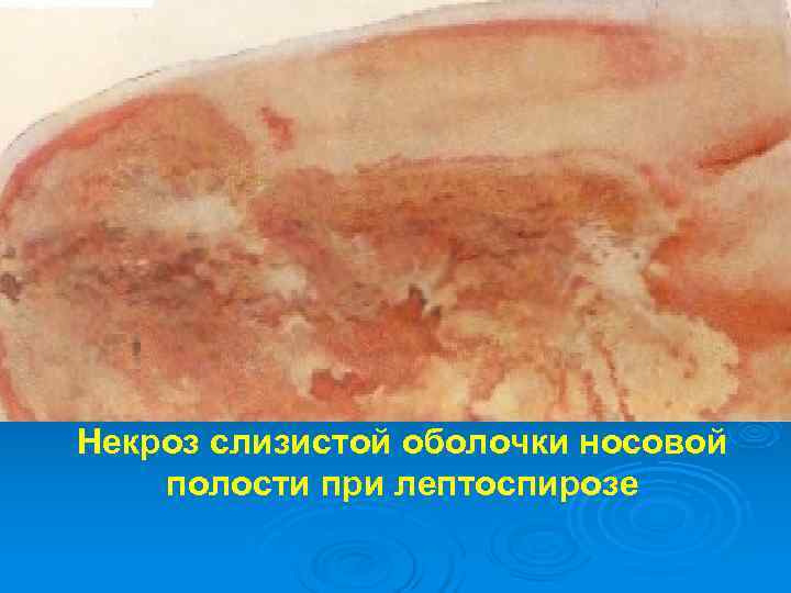 Некроз слизистой оболочки носовой полости при лептоспирозе 