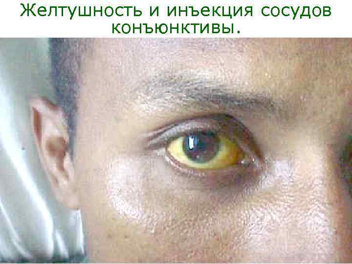 Желтушность и инъекция сосудов   конъюнктивы. 