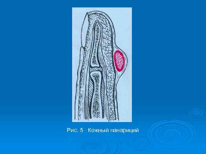 Рис. 5 Кожный панариций 