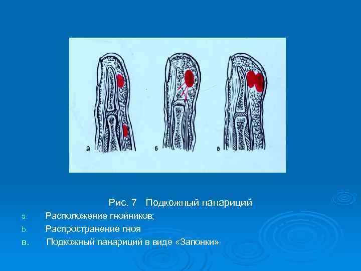    Рис. 7 Подкожный панариций a.  Расположение гнойников; b.  Распространение