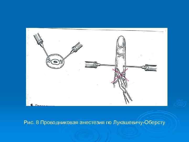 Рис. 8 Проводниковая анестезия по Лукашевичу-Оберсту 