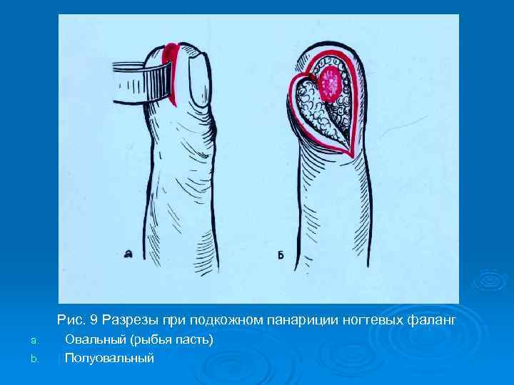  Рис. 9 Разрезы при подкожном панариции ногтевых фаланг a. Овальный (рыбья пасть) b.