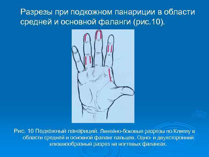  Разрезы при подкожном панариции в области  средней и основной фаланги (рис. 10).