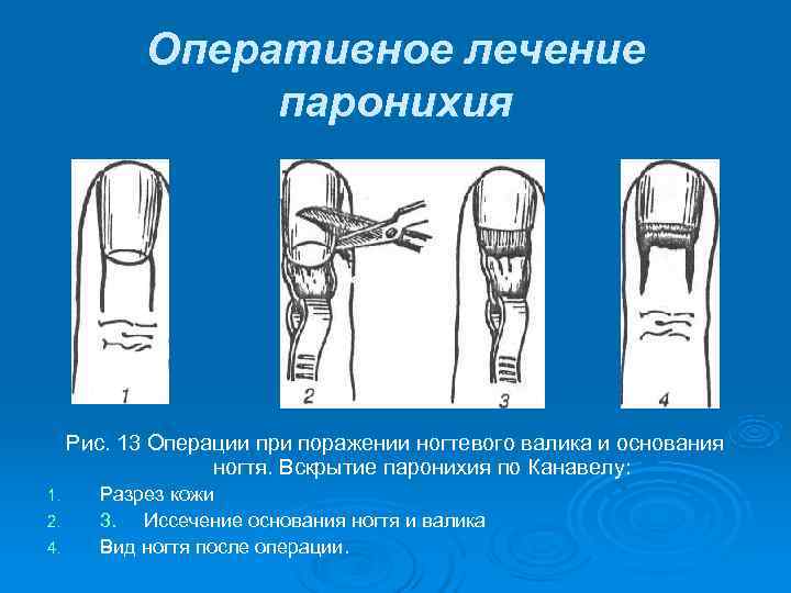   Оперативное лечение   паронихия   Рис. 13 Операции при поражении