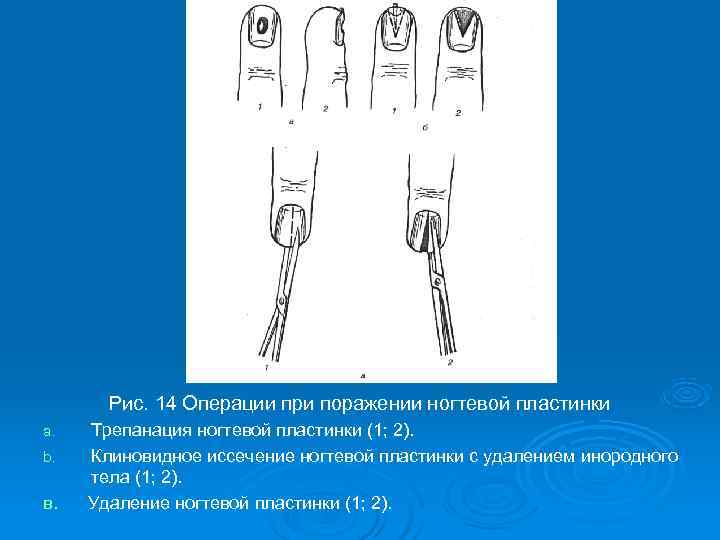   Рис. 14 Операции при поражении ногтевой пластинки a.  Трепанация ногтевой пластинки