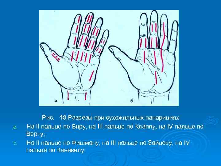   Рис. 18 Разрезы при сухожильных панарициях a.  На II пальце по
