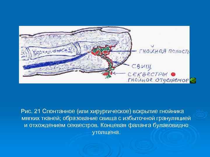 Рис. 21 Спонтанное (или хирургическое) вскрытие гнойника мягких тканей; образование свища с избыточной грануляцией