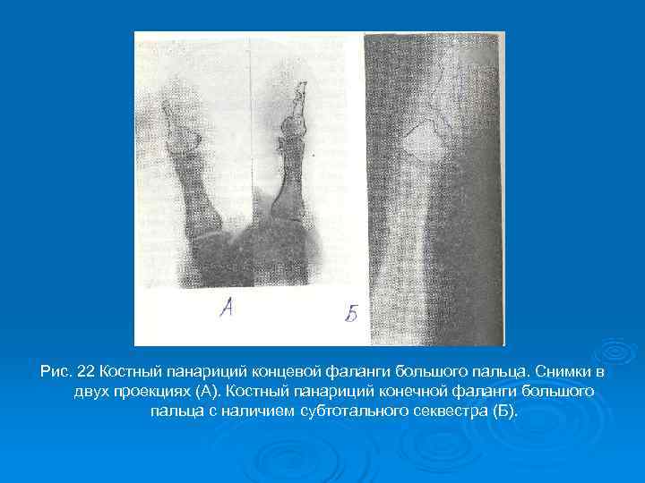 Рис. 22 Костный панариций концевой фаланги большого пальца. Снимки в двух проекциях (А). Костный