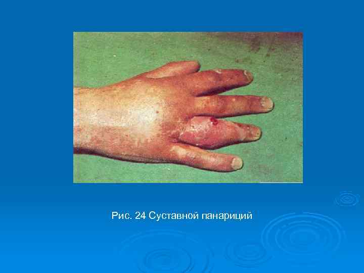 Рис. 24 Суставной панариций 