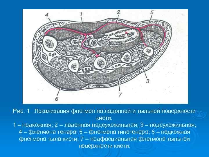 Рис. 1 Локализация флегмон на ладонной и тыльной поверхности     кисти.